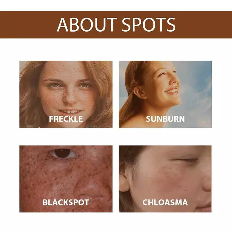 Anti Freckle Serum Limited Time Offer